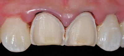 有种植牙可以做牙齿矫正吗(有种植牙可以矫正牙齿吗)