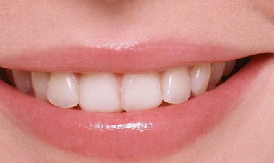 牙齿激光美白能管多久
