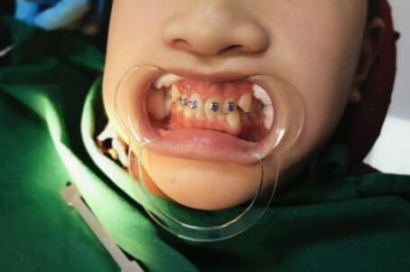 在广州牙齿矫正一般多少钱