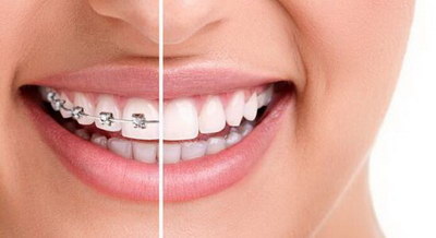 莆田哪个牙齿矫正好(在莆田如何选取一家优质的牙齿矫正机构？)