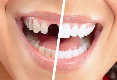 牙髓炎治疗要多少_牙髓炎要做手术吗