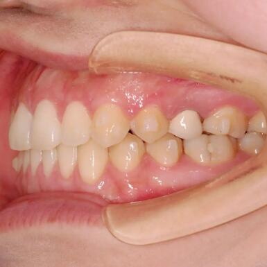 最里面牙齿蛀了个洞_牙齿预防性填充