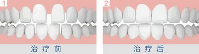容易形成龋齿的原因是什么?(容易形成龋齿的原因)