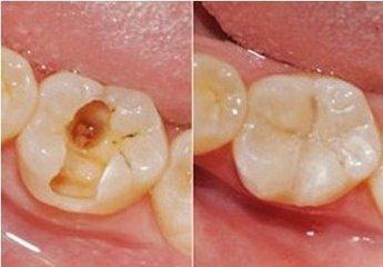 牙齿缺了一小块会有什么影响吗