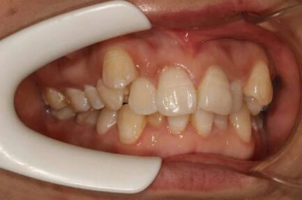 牙根管发炎的原因_牙齿蛀洞就要做根管治疗吗