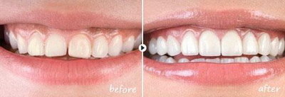 牙齿漂白的正确方法_牙齿漂白需要做哪些工作