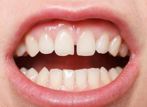 根管治疗后打桩镶牙能用多久(打桩根管治疗的牙能用多久)