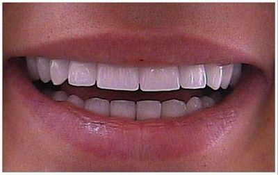 牙齿矫正可以医保