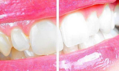 牙套的种类与优缺点