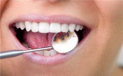 牙齿敏感需要洗牙吗(牙齿敏感需要补牙吗)