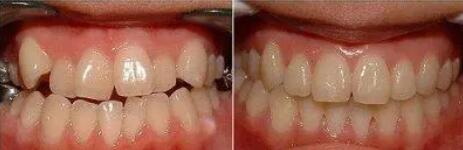 牙齿酸应该看什么科室_为什么刷牙牙齿还是有黑点