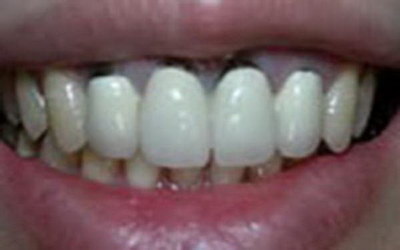 虫牙做根管治疗是什么步骤(虫牙根管治疗是什么)