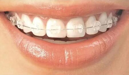 请问洗牙多少钱一次_洗牙多少钱一次能把牙齿洗白