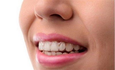 成年人带牙套还能矫正牙齿吗