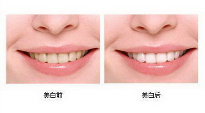 牙齿矫正：最好的选择来保护和完善你的微笑