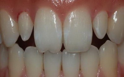 根管治疗后必须做牙套吗_牙齿做完根管治疗需要做牙套吗
