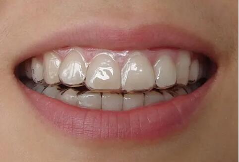 蛀牙形成的原因龋齿(蛀牙形成原因——龋齿)