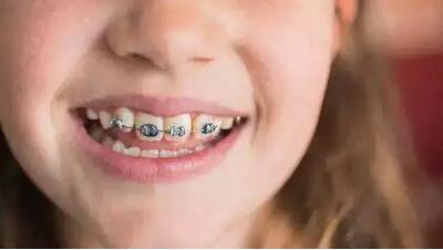 怎样选牙套_带金属的牙套对牙龈有多大的影响
