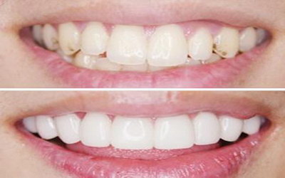 外源性牙黄洗牙能变白吗