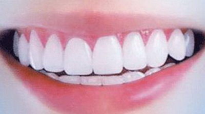 全瓷牙的分类_全瓷牙的品牌有哪些