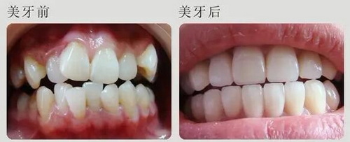 牙齿瘘管治疗方法