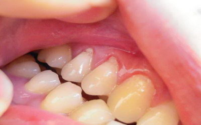 换牙期牙菌斑如何彻底清除_换牙期如何让牙齿快速脱落