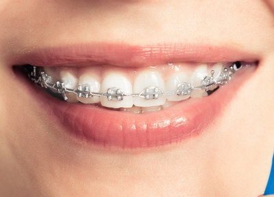 乳牙反颌最佳矫治器_乳牙反颌矫正两阶段