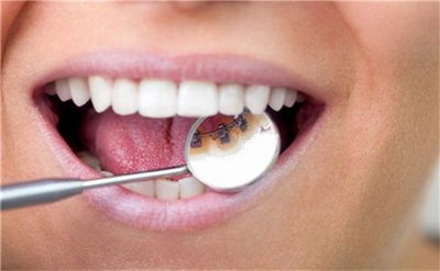 哺乳期可以做牙齿矫正(哺乳期可以做牙齿矫正给牙齿拍片吗)