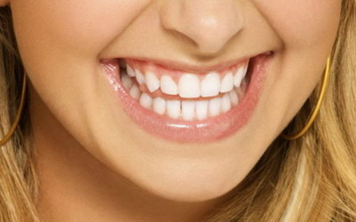 成年矫正牙齿是否都需要拔牙