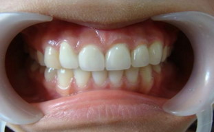 补过的牙齿可以用牙线吗_补过的牙齿能用牙贴么