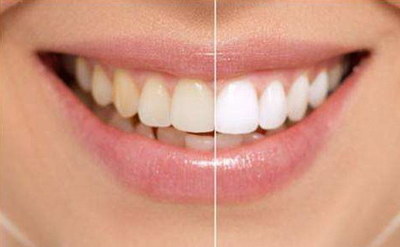 怎么诊疗牙齿美容_广州的牙齿美容