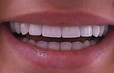 牙槽骨凸出_成人牙槽骨突出矫正方法