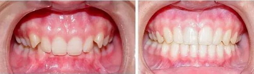 小时候喝井水导致牙黄_外源性牙黄洗牙能变白吗