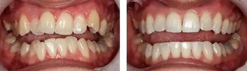 医院拔牙和诊所拔牙的区别(牙科诊所拔牙和医院拔牙的区别)