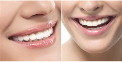 电动牙刷对牙齿有什么作用_电动牙刷对牙齿有损害吗