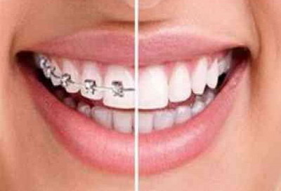 牙齿间出现缝隙是什么原因(牙齿之间突然出现缝隙小洞)