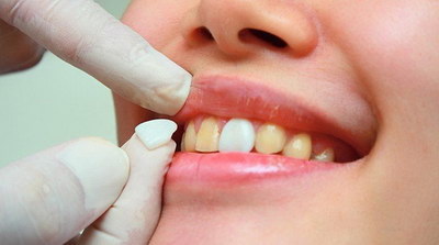 儿童使用含氟牙膏会造成氟斑牙吗