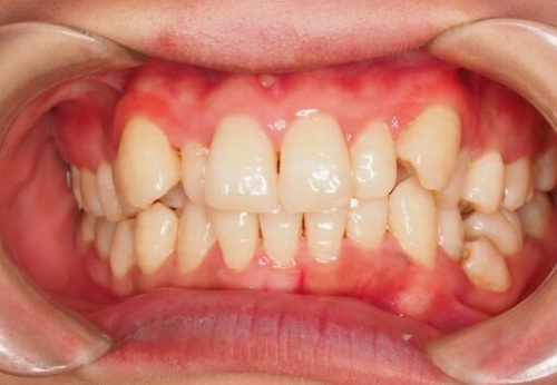 长在最里面的牙齿叫什么(人类最后长出的牙齿——智齿)