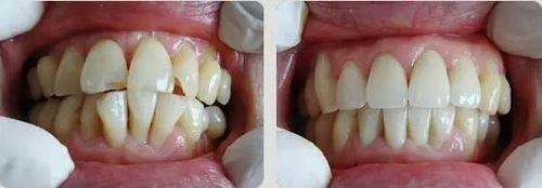 牙套可以改变牙缝吗_为什么牙缝特别大