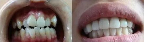 根管治疗填充后牙龈肿疼(根管治疗填充后牙龈肿包)