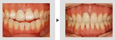 牙根管治疗一般全程需多少天(牙根管治疗后一般能用多少年)