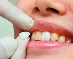 牙齿假神经的副作用