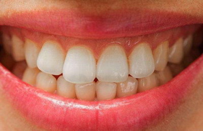 牙齿有小缺口是什么原因