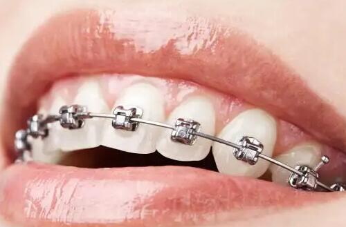 有一点牙结石要洗牙吗(洗牙要看牙结石的程度)