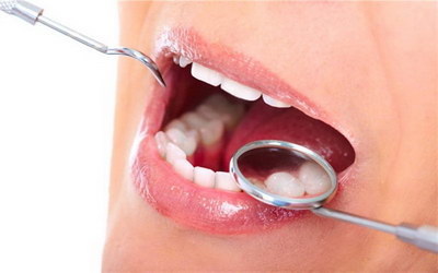 急性牙龈炎的治疗方法