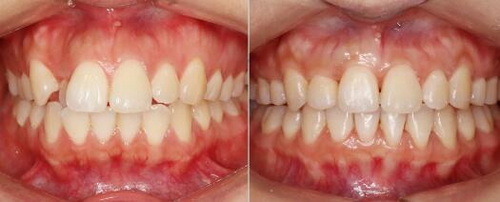 做二氧化锆牙需要磨牙吗