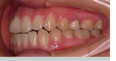 拔牙分根术是什么