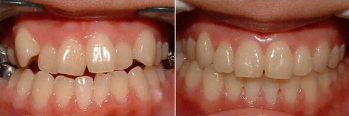 如何是萎缩的牙龈恢复正常_左氧氟沙星治牙龈炎吗
