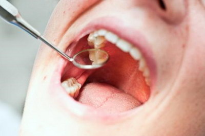 成人牙齿正畸需要注意什么