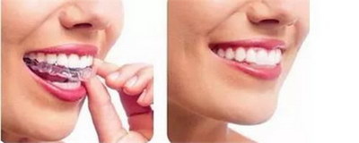正畸牙齿收缝方法(牙齿正畸有几种方法)
